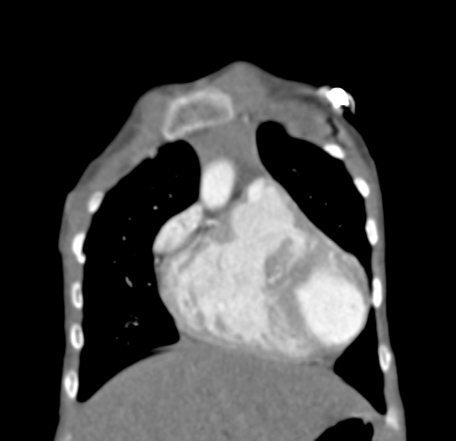 File:Aortopulmonary window, interrupted aortic arch and large PDA giving the descending aorta (Radiopaedia 35573-37074 D 11).jpg