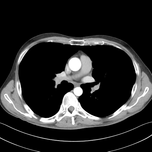 File:Apical pleural calcification (Radiopaedia 46141-50499 Axial C+ delayed 32).png
