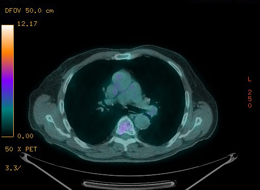 Appendiceal adenocarcinoma complicated by retroperitoneal abscess (Radiopaedia 58007-65041 Axial PET-CT 64).jpg