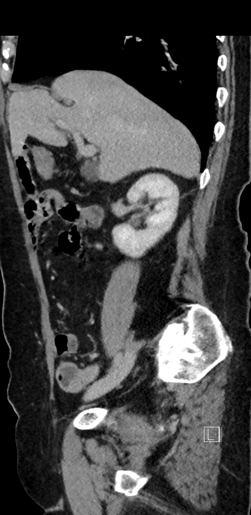 Appendiceal hemorrhage (Radiopaedia 70830-81025 Sagittal C+ delayed 41).jpg