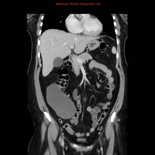Appendiceal mucinous cystadenoma (Radiopaedia 8263-9111 B 28).jpg