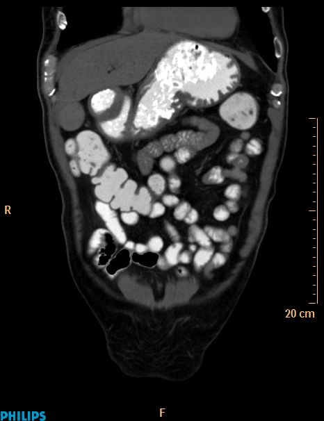Appendiceal mucocoele (Radiopaedia 29449-29917 E 49).jpg