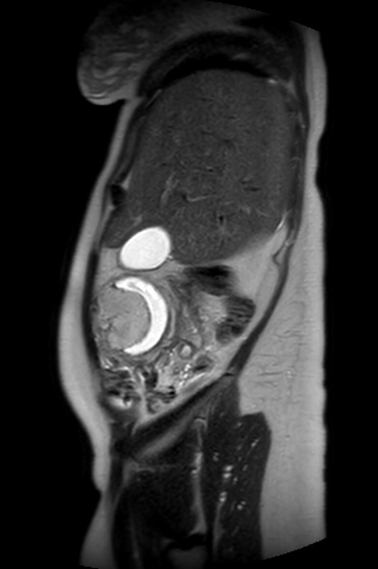 Appendicitis in gravida (MRI) (Radiopaedia 89433-106395 Sagittal T2 53).jpg