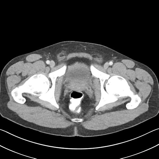 Appendicitis with cecal bar sign (Radiopaedia 31878-32830 B 79).jpg