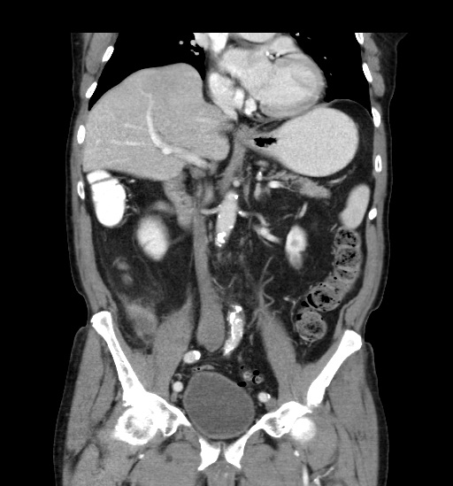 Appendicitis with localized perforation and abscess formation (Radiopaedia 49035-54130 B 25).jpg