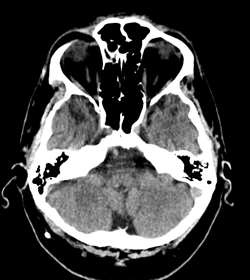 File:Aqueduct stenosis with corpus callosum hypoattenuation post shunting (Radiopaedia 37212-38971 Axial non-contrast 6).png