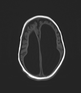 File:Aqueductal stenosis (Radiopaedia 73974-84802 Axial T1 18).jpg