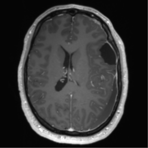 Arachnoid cyst with subdural hematoma (Radiopaedia 85892-101743 Axial T1 C+ 52).png