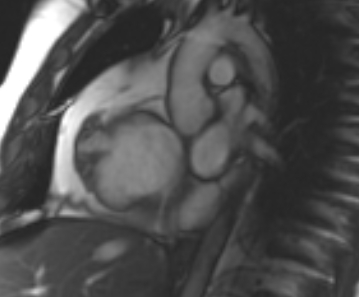 File:Arrhythmogenic right ventricular cardiomyopathy (Radiopaedia 69431-79307 Short axis cine 237).jpg
