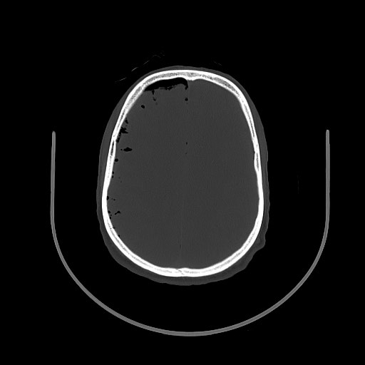 Arrow injury to the brain (Radiopaedia 72101-82607 Axial bone window 80).jpg