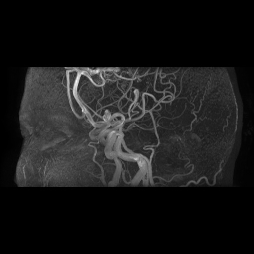 Arteriovenous malformation (Radiopaedia 71628-81999 Axial MRA 4).jpg