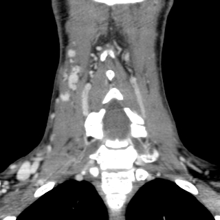 Arteriovenous malformation of the neck (Radiopaedia 53935-60062 D 26).jpg