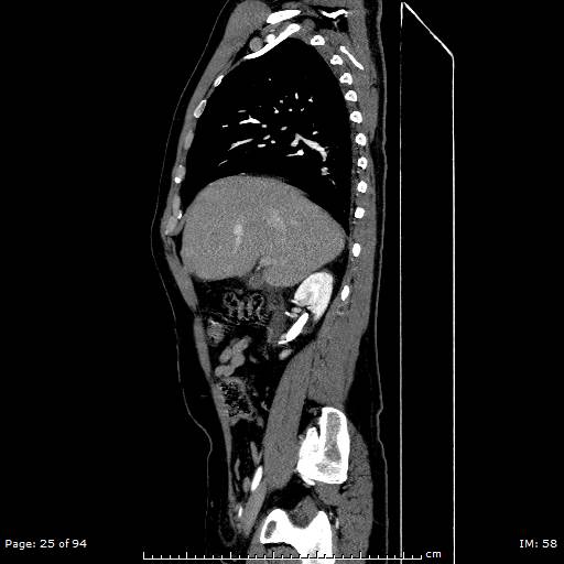File:Ascending aortic aneurysm (Radiopaedia 50086-55404 C 18).jpg