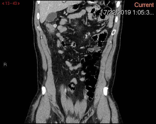 File:Ascending colonic diverticulum mimicking acute appendicitis (Radiopaedia 69943-80198 B 43).jpg