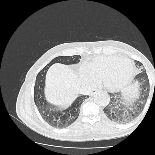 Aspergilloma (Radiopaedia 44592-48327 Axial lung window 72).jpg