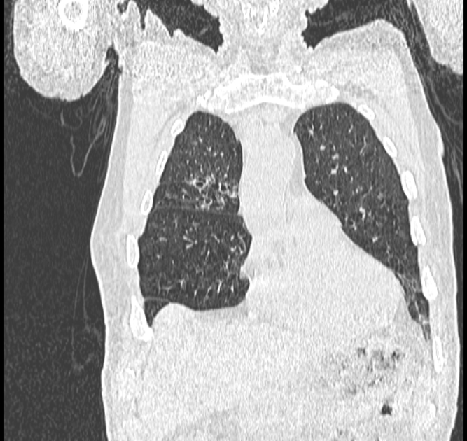 Aspergilloma (Radiopaedia 44592-48327 Coronal lung window 25).jpg