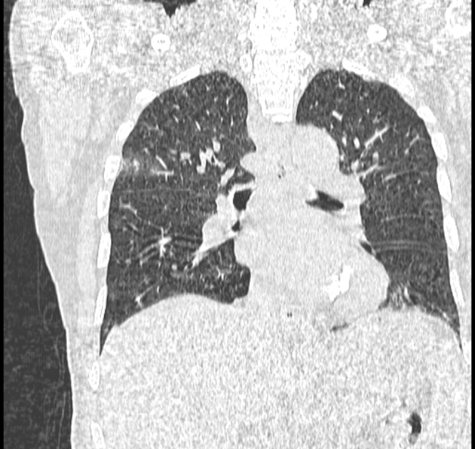 Aspergilloma (Radiopaedia 44592-48327 Coronal lung window 72).jpg