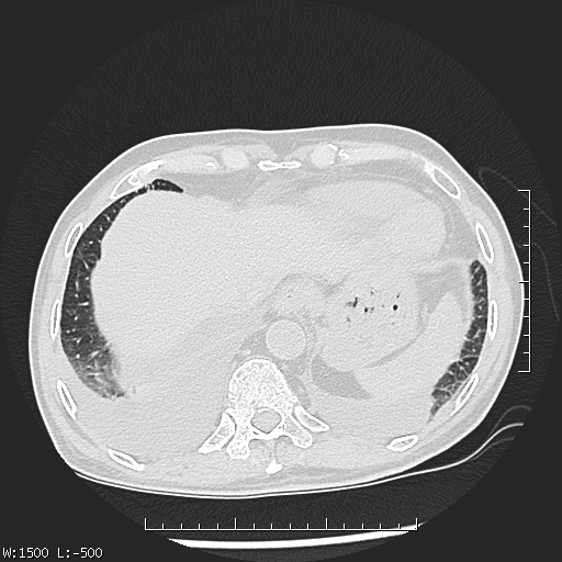 File:Aspergilloma (Radiopaedia 75184-86270 Axial lung window 46).jpg