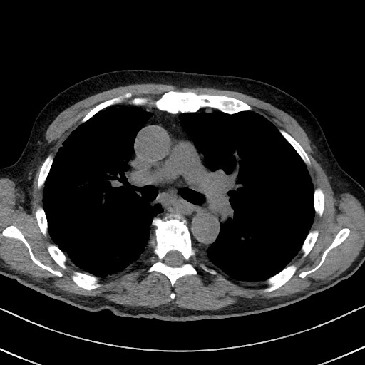 File:Aspergilloma on background pulmonary fibrosis (Radiopaedia 60942-68757 Axial non-contrast 26).jpg