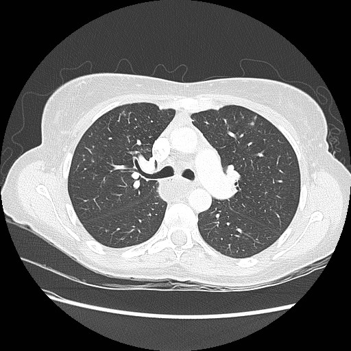 Aspiration pneumonia secondary to laparoscopic banding (Radiopaedia 18345-18183 lung window 40).jpg
