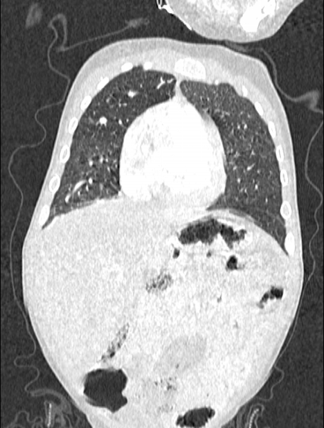 Asplenia syndrome (Radiopaedia 73083-83792 Coronal lung window 36).jpg