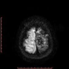 File:Astroblastoma (Radiopaedia 74287-85162 Axial DWI 103).jpg