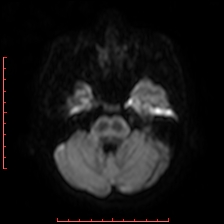 Astroblastoma (Radiopaedia 74287-85162 Axial DWI 24).jpg