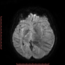 Astroblastoma (Radiopaedia 74287-85162 Axial DWI 47).jpg