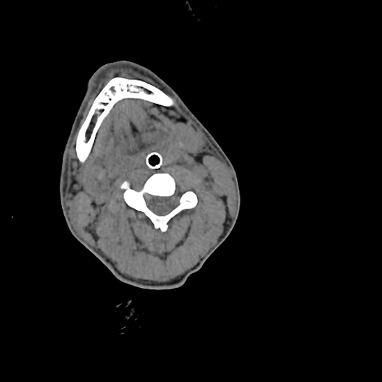 File:Atlanto-occipital dissociation (Traynelis type 1), C2 teardrop fracture, C6-7 facet joint dislocation (Radiopaedia 87655-104061 Axial non-contrast 36).jpg