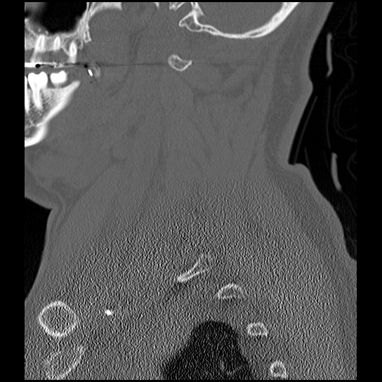 Atlanto-occipital dissociation injury (Radiopaedia 29274-29698 Sagittal bone window 12).png