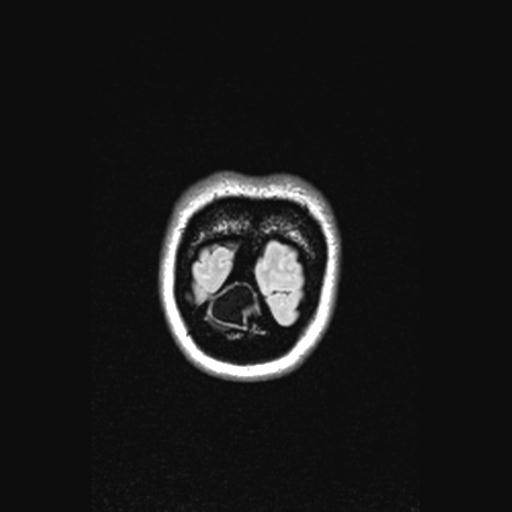 Atretic encephalocoele with inferior vermis hypoplasia (Radiopaedia 30443-31108 Coronal FLAIR 16).jpg