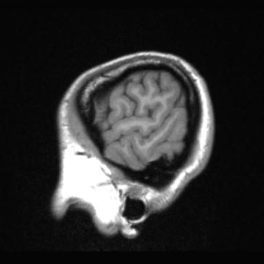 Atretic encephalocoele with inferior vermis hypoplasia (Radiopaedia 30443-31108 Sagittal T1 8).jpg