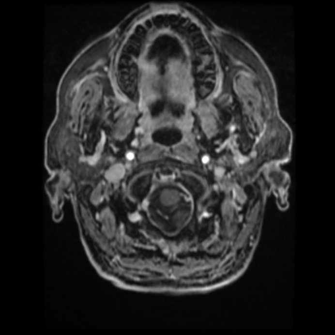 Atypical meningioma (Radiopaedia 45535-49629 Axial T1 C+ 15).jpg