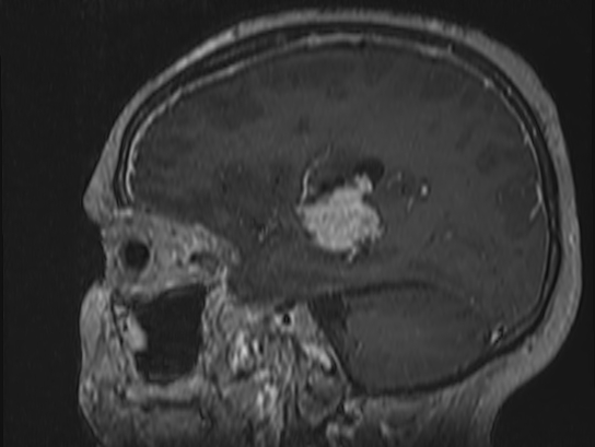 Atypical meningioma (Radiopaedia 62985-71406 Sagittal T1 C+ 62).jpg