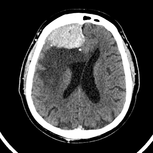 Atypical meningioma (WHO grade II) with brain invasion (Radiopaedia 57767-64728 Axial C+ 23).png