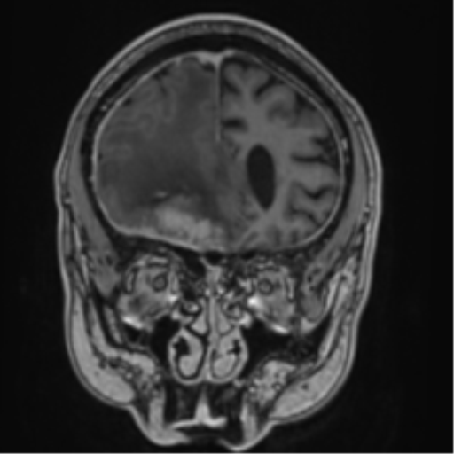 Atypical meningioma (WHO grade II) with brain invasion (Radiopaedia 57767-64729 Coronal T1 C+ 20).png