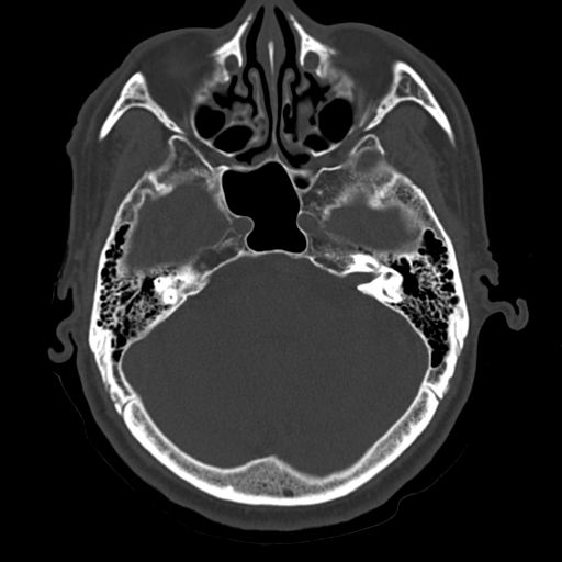 Atypical meningioma (WHO grade II) with osseous invasion (Radiopaedia 53654-59715 Axial bone window 23).png