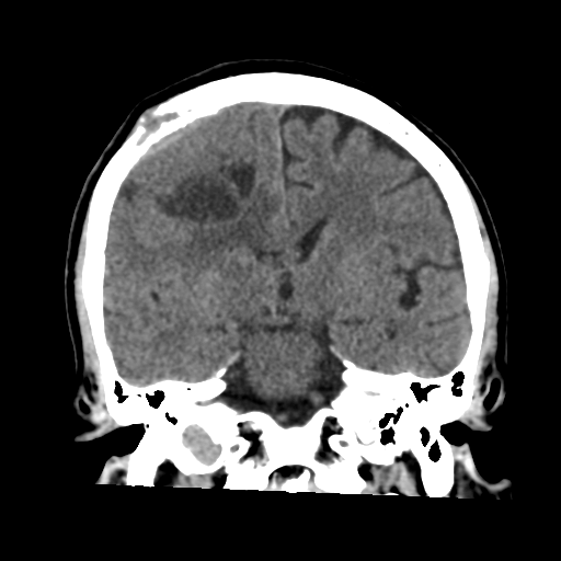 Atypical meningioma (WHO grade II) with osseous invasion (Radiopaedia 53654-59715 Coronal non-contrast 34).png