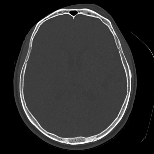 Atypical meningioma with skull invasion (Radiopaedia 34357-35649 Axial bone window 46).png