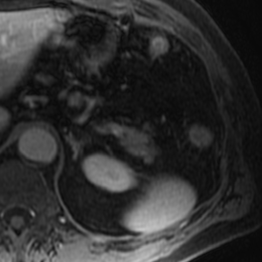 File:Atypical renal cyst on MRI (Radiopaedia 17349-17046 D 4).jpg