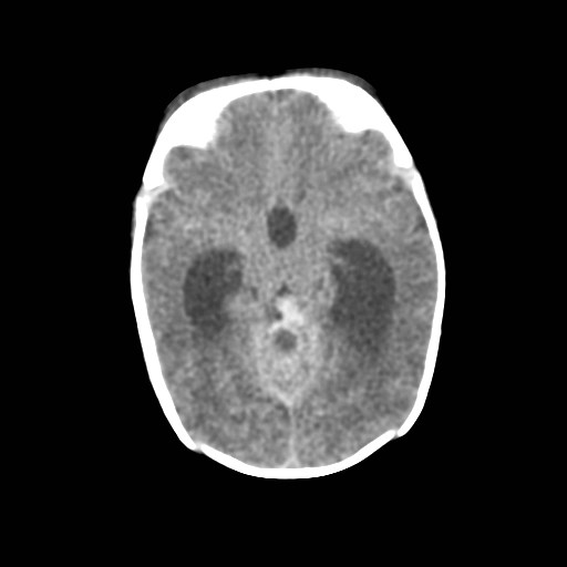 File:Atypical teratoid rhabdoid tumor (prenatal US and neonatal MRI) (Radiopaedia 59091-66387 Axial non-contrast 18).jpg