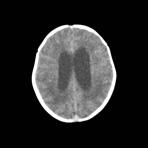 File:Atypical teratoid rhabdoid tumor (prenatal US and neonatal MRI) (Radiopaedia 59091-66387 Axial non-contrast 28).jpg