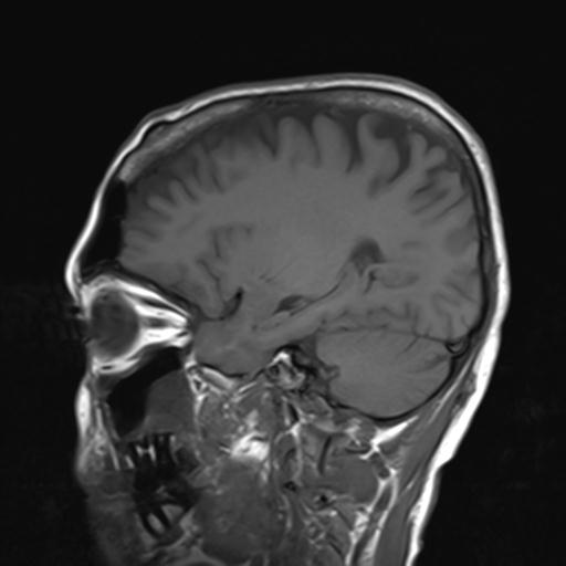 File:Autoimmune limbic encephalitis (Radiopaedia 30363-31005 Sagittal T1 8).jpg