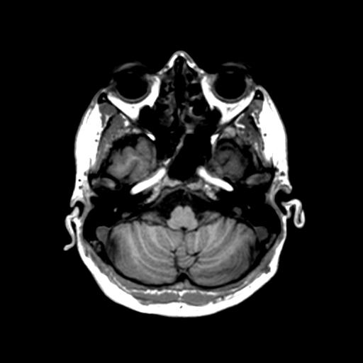 Autoimmune limbic encephalitis (Radiopaedia 30363-31005 T1 Axial 1mm 36).jpg