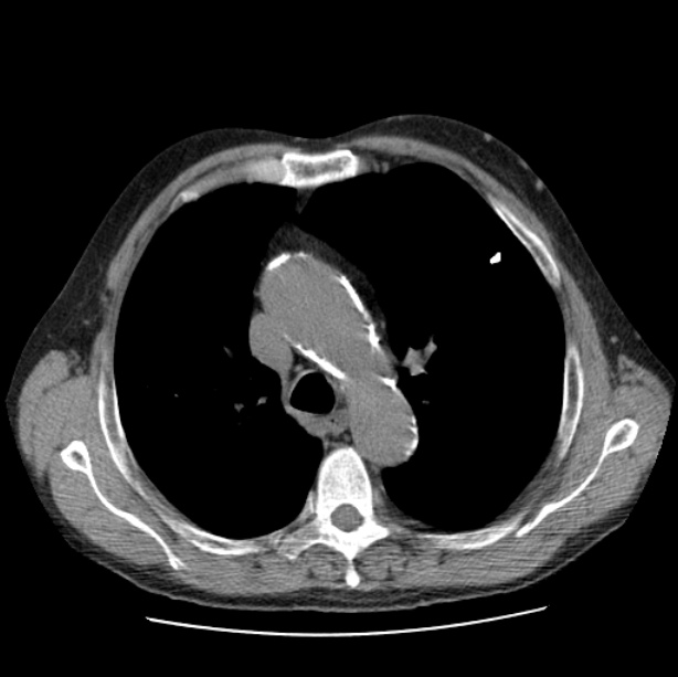 Autosomal dominant polycystic kidney disease (Radiopaedia 27851-28094 Axial non-contrast 19).jpg