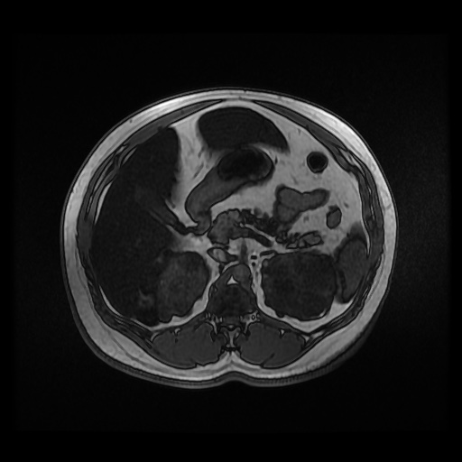 Autosomal dominant polycystic kidney disease (Radiopaedia 50259-55611 Axial 2D Dual Echo 37).jpg