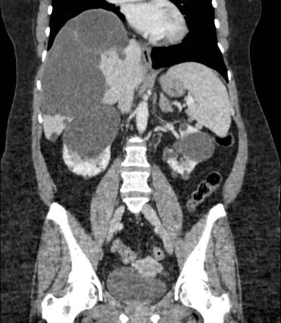 Autosomal dominant polycystic kidney disease (Radiopaedia 57124-64017 B 44).jpg