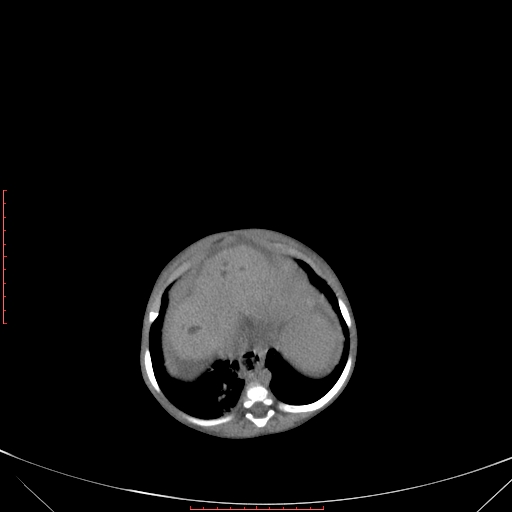File:Autosomal recessive polycystic kidney disease associated with Caroli disease (Radiopaedia 61932-69984 Axial non-contrast 101).jpg