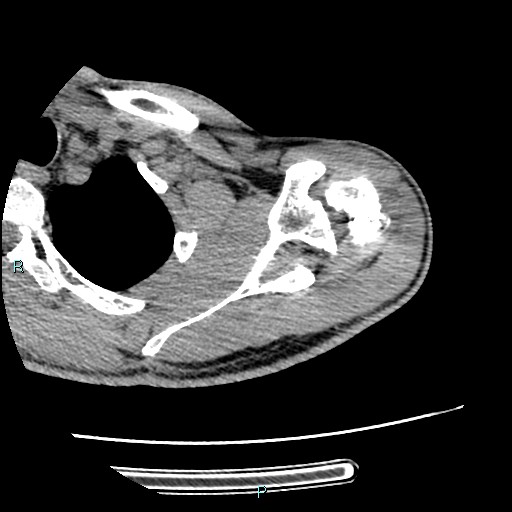 Avascular necrosis after fracture dislocations of the proximal humerus (Radiopaedia 88078-104655 D 39).jpg