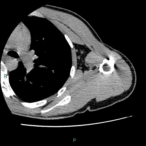 File:Avascular necrosis after fracture dislocations of the proximal humerus (Radiopaedia 88078-104655 D 78).jpg